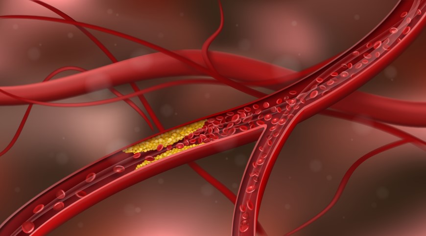 Jak snížit cholesterol